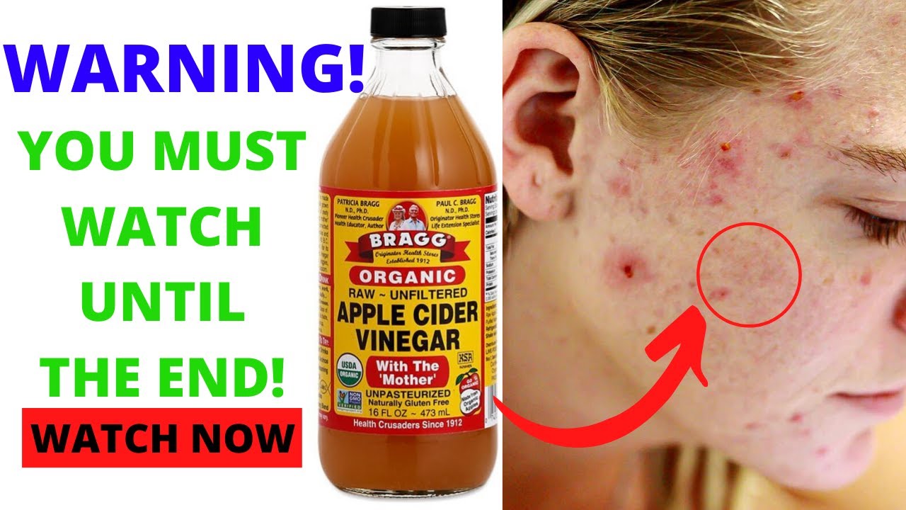 Apple cider vinegar is made through a two-step fermentation process. First, the apples are crushed and the liquid is extracted. Then, bacteria and yeast are added to the liquid to start the fermentation process. The end result is a sour and pungent vinegar-like liquid that is packed with nutrients and minerals.